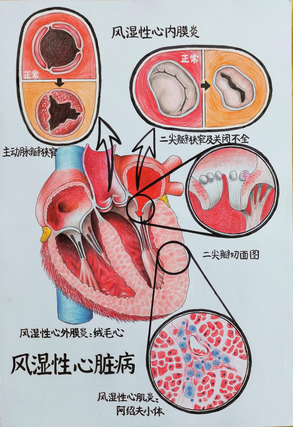 2. 邮寄手绘 作品分类 2 风湿性心脏病 太阳集团tyc5997 张晨彤