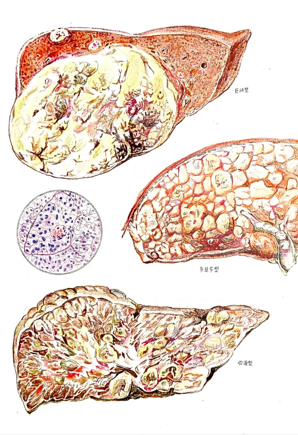5. 邮寄手绘 作品分类 2 肝细胞癌的病理变化 太阳集团tyc5997 韩培航